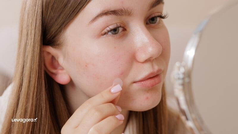 Pele com tendência à acne
