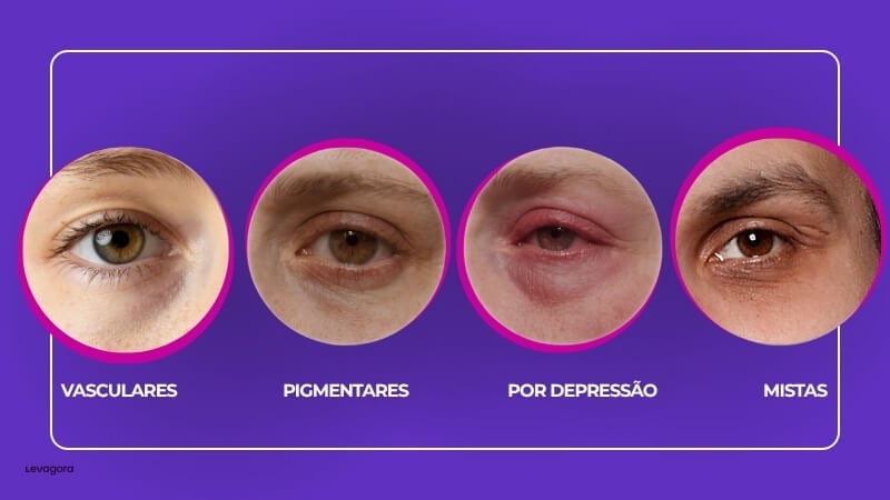 Tipos de Olheiras Aprenda a Identificar a Sua para Tratar Melhor