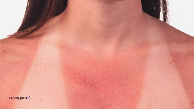 Cuidados com pescoço, colo e mãos no skincare diário Mulher com o colo queimado pelo sol, evidenciando manchas e danos causados pela falta de cuidados com pescoço e colo